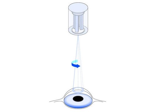 High-Precision Drives in Ophthalmic Surgery High-Precision Drives in Ophthalmic Surgery